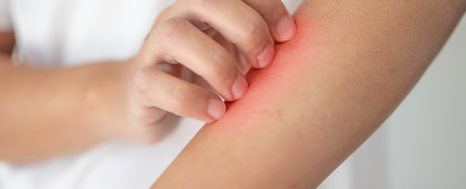 Itchiness and eczema due to smoke exposure